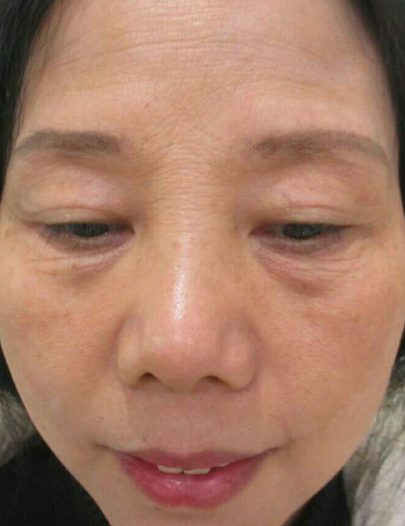 去眼袋手术