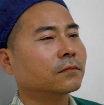 去眼袋手术