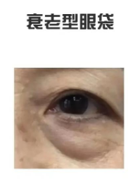 去眼袋手术