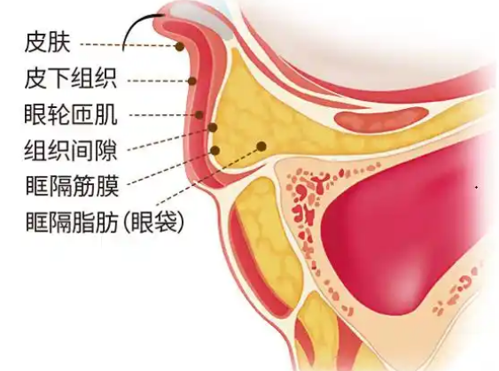 去眼袋手术