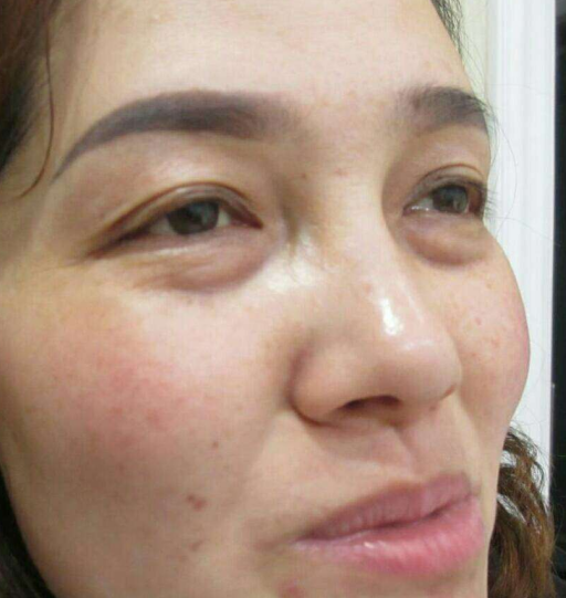去眼袋手术