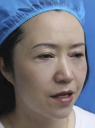 去眼袋手术