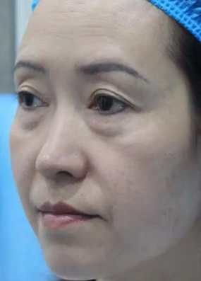 去眼袋手术
