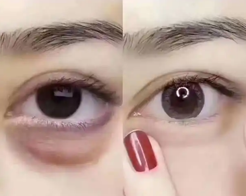 去眼袋手术