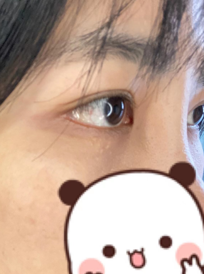 去眼袋手术