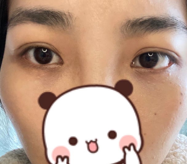 去眼袋手术