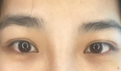 去眼袋手术