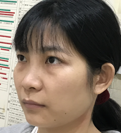 去眼袋手术
