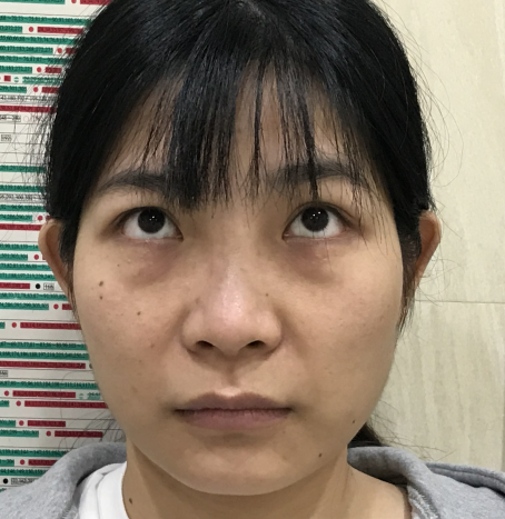 去眼袋手术