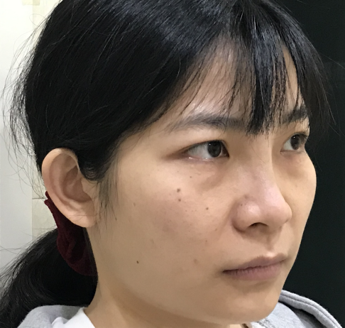 去眼袋手术