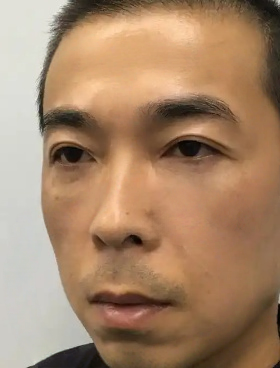 去眼袋手术
