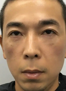 去眼袋手术
