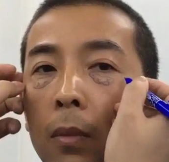 去眼袋手术