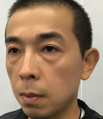 去眼袋手术