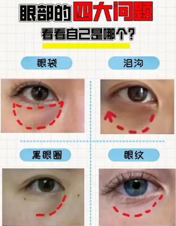 去眼袋手术