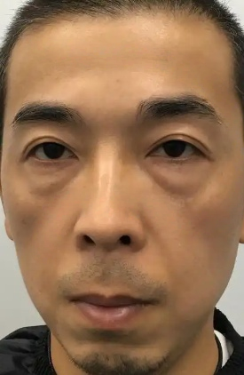 去眼袋手术
