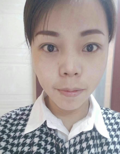 去眼袋手术