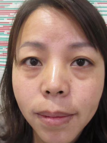 去眼袋手术