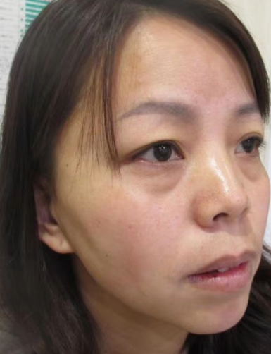 去眼袋手术