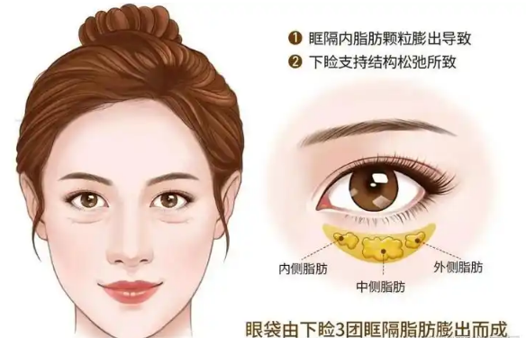 去眼袋手术