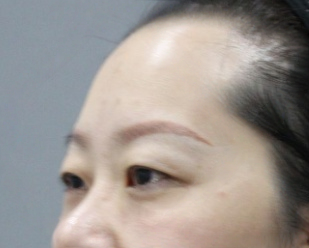 去眼袋手术