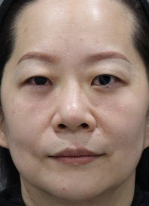 去眼袋手术