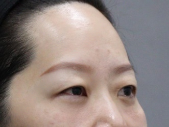 去眼袋手术