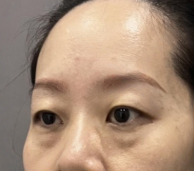 去眼袋手术