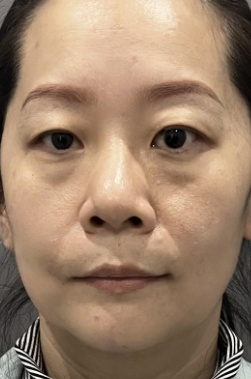 去眼袋手术