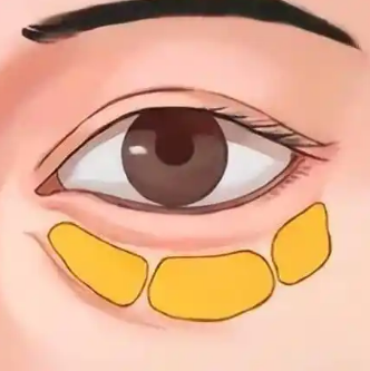 去眼袋手术