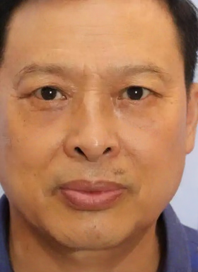 去眼袋手术