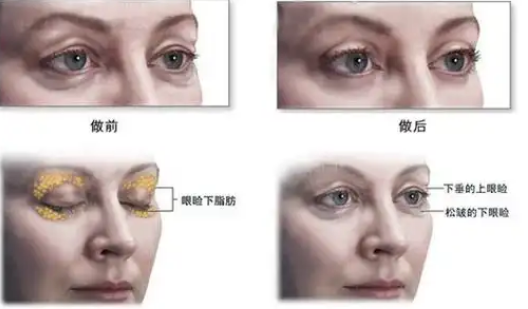 去眼袋手术