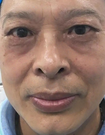 去眼袋手术
