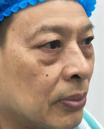 去眼袋手术