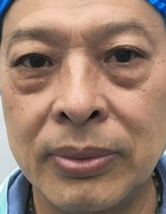 去眼袋手术