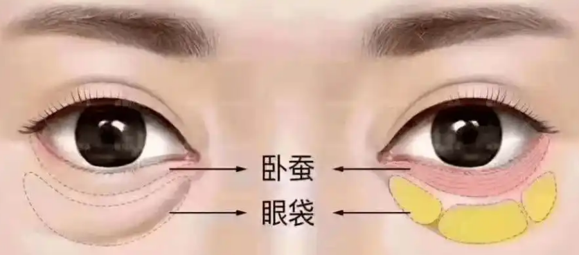 去眼袋手术