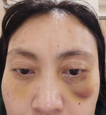 去眼袋手术