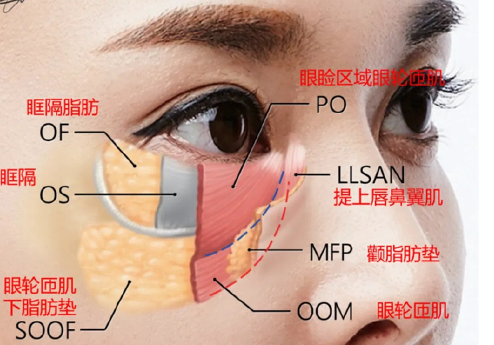 去眼袋手术