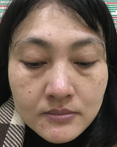 去眼袋手术