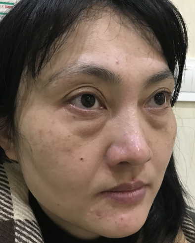 去眼袋手术