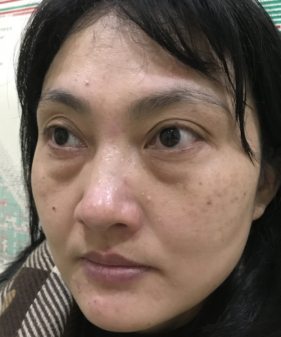 去眼袋手术