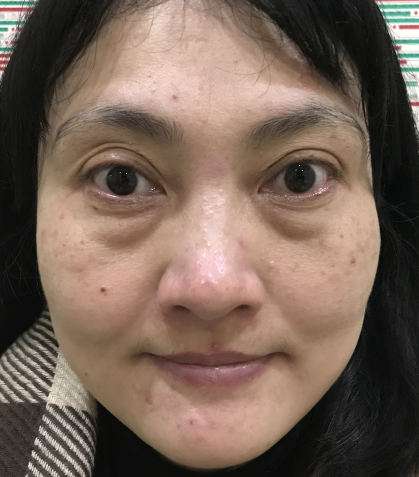 去眼袋手术