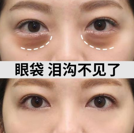 去眼袋手术