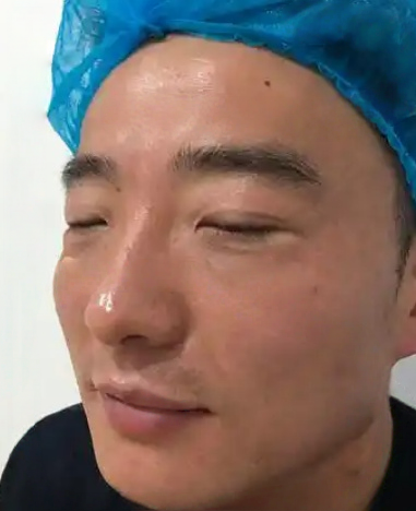 去眼袋手术