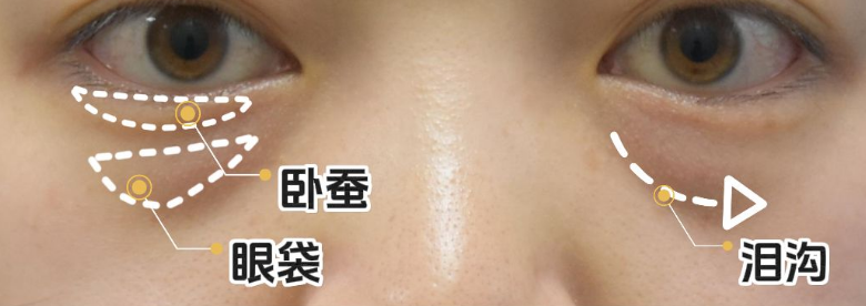 去眼袋手术