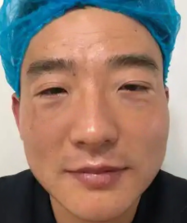 去眼袋手术