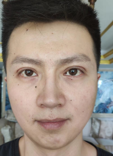 去眼袋手术