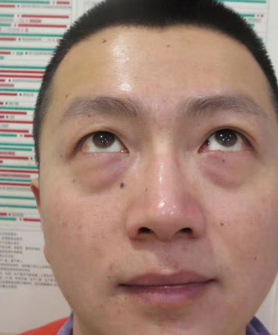 去眼袋手术