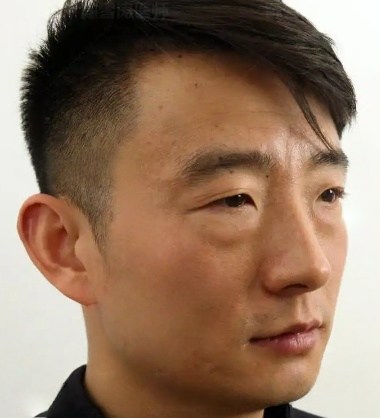 去眼袋手术