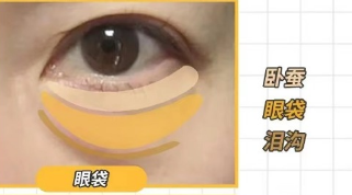 去眼袋手术
